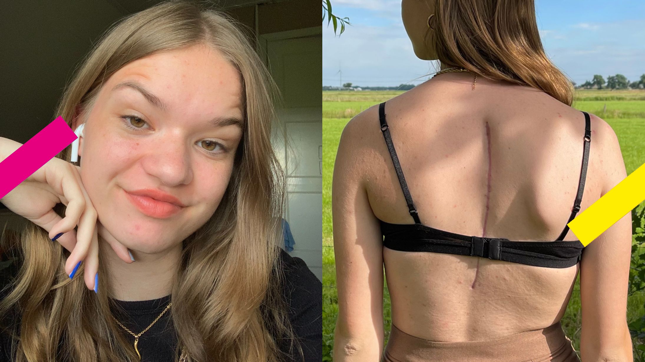 Sarah (15) heeft 12 schroeven en 2 staven in haar rug: ‘Mijn litteken vertelt mijn verhaal’